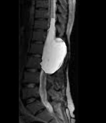 Spinal tumor classification publication preview